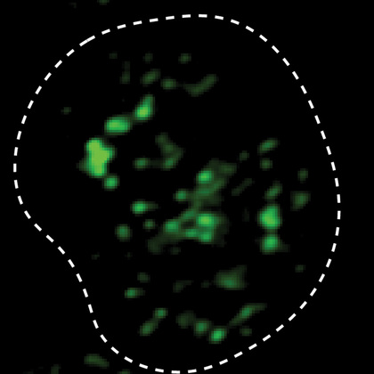 Study uncovers how biomolecular condensates cause some kidney cancers