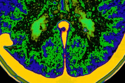 brain scan
