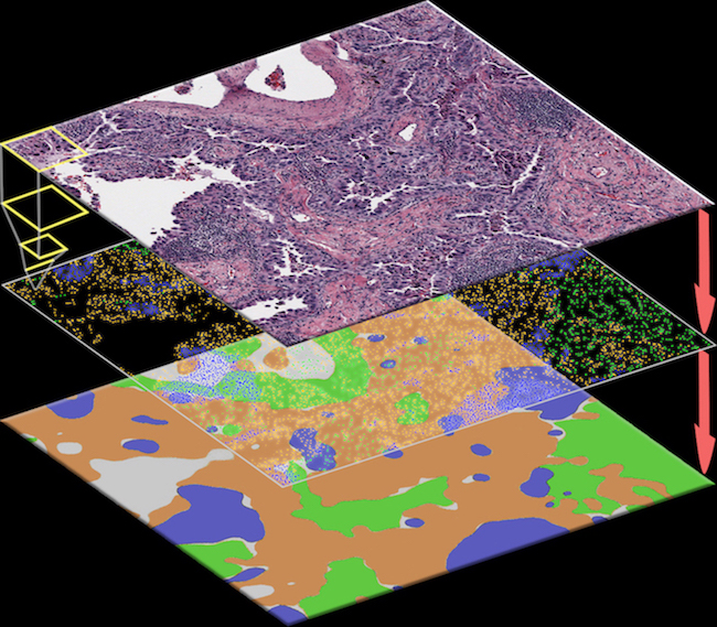Byron Davis This illustration of the ConvPath software workflow shows how the AI algorithm automatically recognizes each cell in the pathology image (upper image) as a tumor cell (orange), stromal cell (green), or lymphocyte (blue), then converts the image into a spatial map (middle image). Clusters of tumor cells are further identified as tumor regions (orange areas in the bottom image).